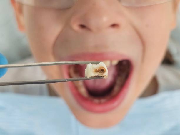 Best Broken or Chipped Tooth Repair in Kountze, TX