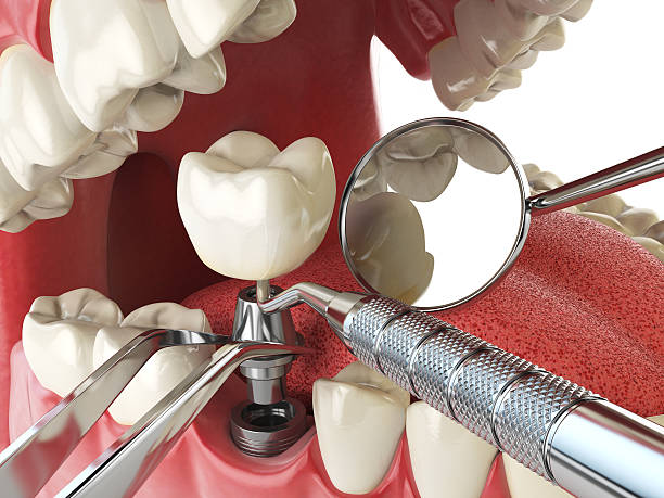 Best Emergency Root Canal Therapy in Kountze, TX